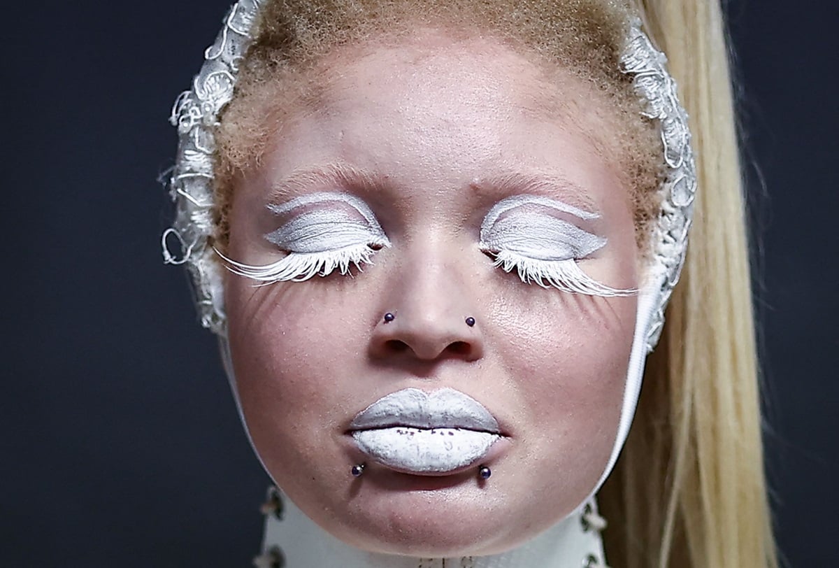 Ilustrasi - Model penderita albinisme