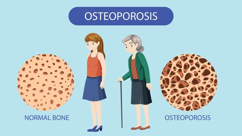 Perempuan Berisiko Osteoporosis Cek dengan Pemeriksaaan Kepadatan Perempuan Berisiko Osteoporosis Cek dengan Pemeriksaaan Kepadatan