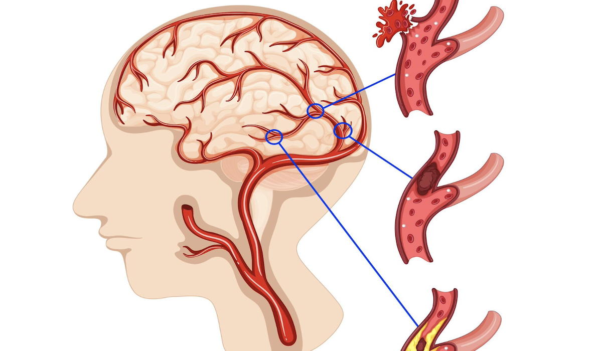 Ilustrasi penyebab stroke di usia muda