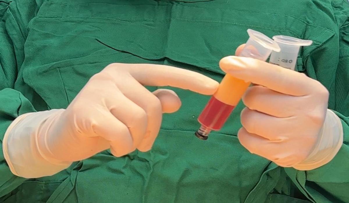 Teknologi kecantikan Fat Filler