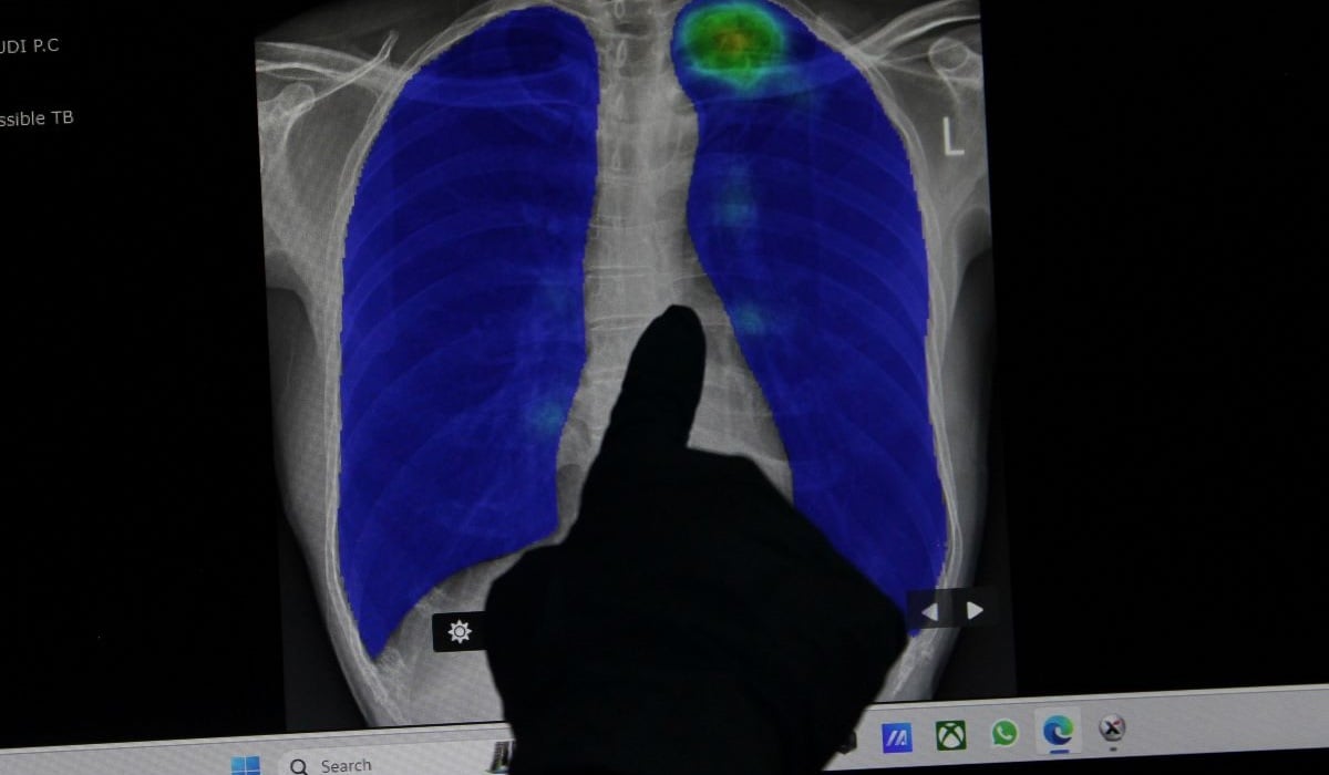 Petugas medis memperlihatkan hasil rontgen paru-paru warga terindikasi TBC saat pemeriksaan di SDN Duren Tiga 01, Jakarta.