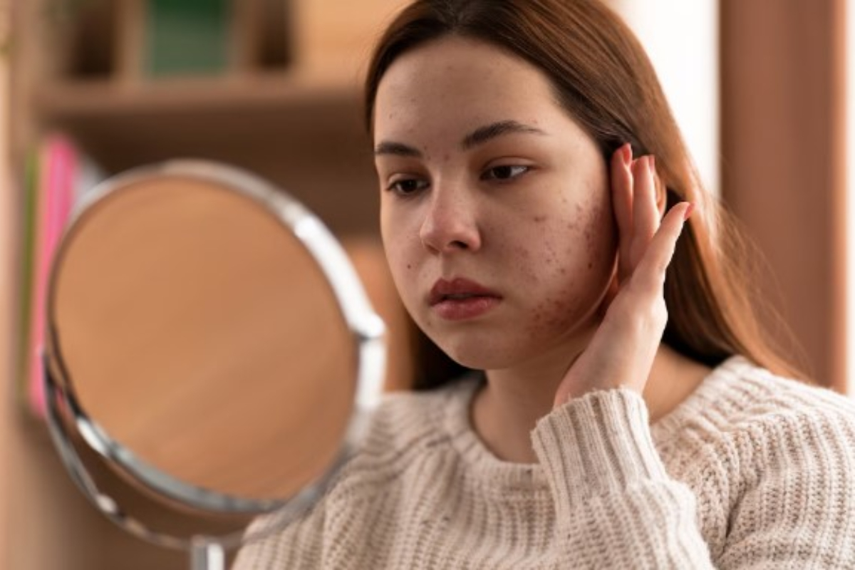 Ilustrasi, berikut cara menghilangkan bekas jerawat di wajah