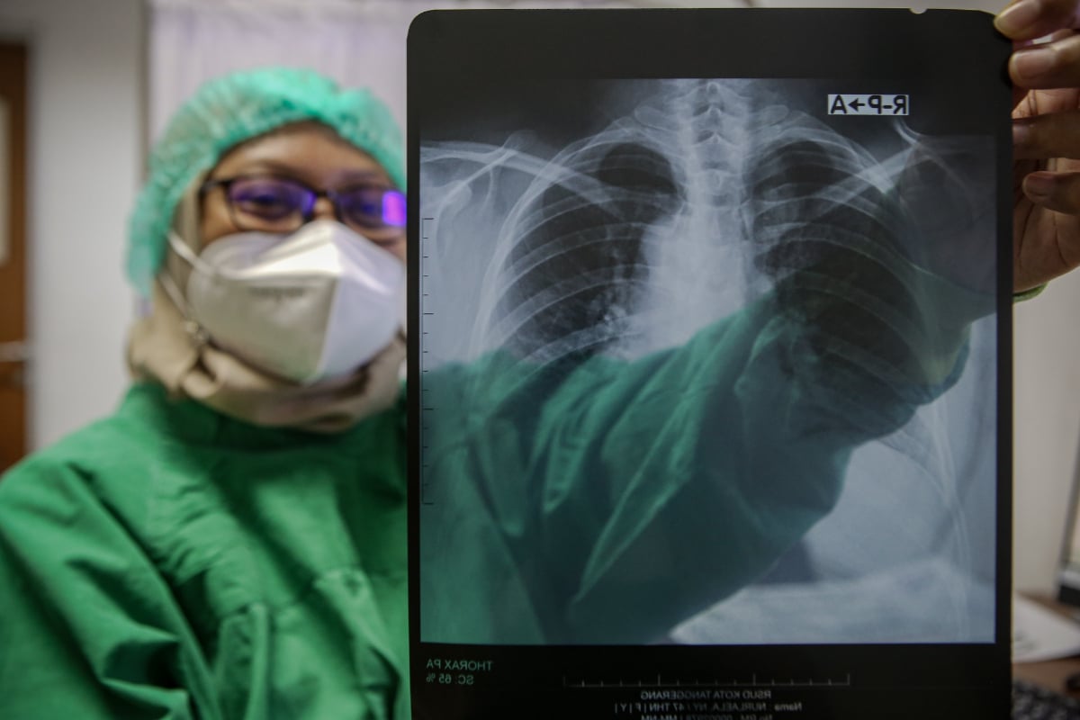 Ilustrasi, Tenaga kesehatan menunjukkan hasil rontgen thorax salah satu pasien di RSUD Kota Tangerang, Banten