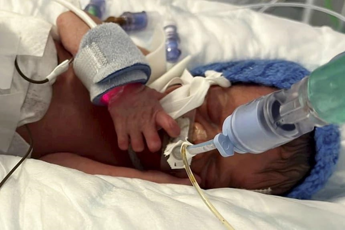 Uzziah Bowman, bayi berusia seminggu dari Inggris, lahir dengan epidermolysis bullosa (EB)