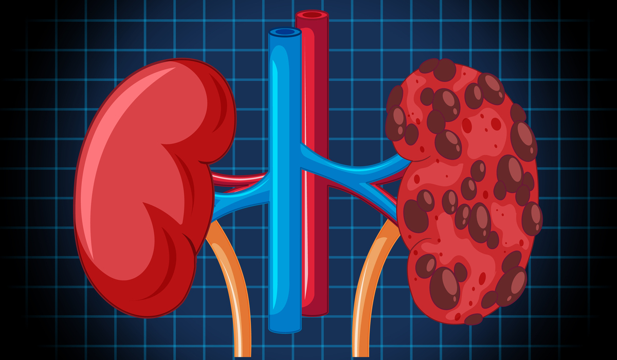 Ilustrasi ginjal manusia.