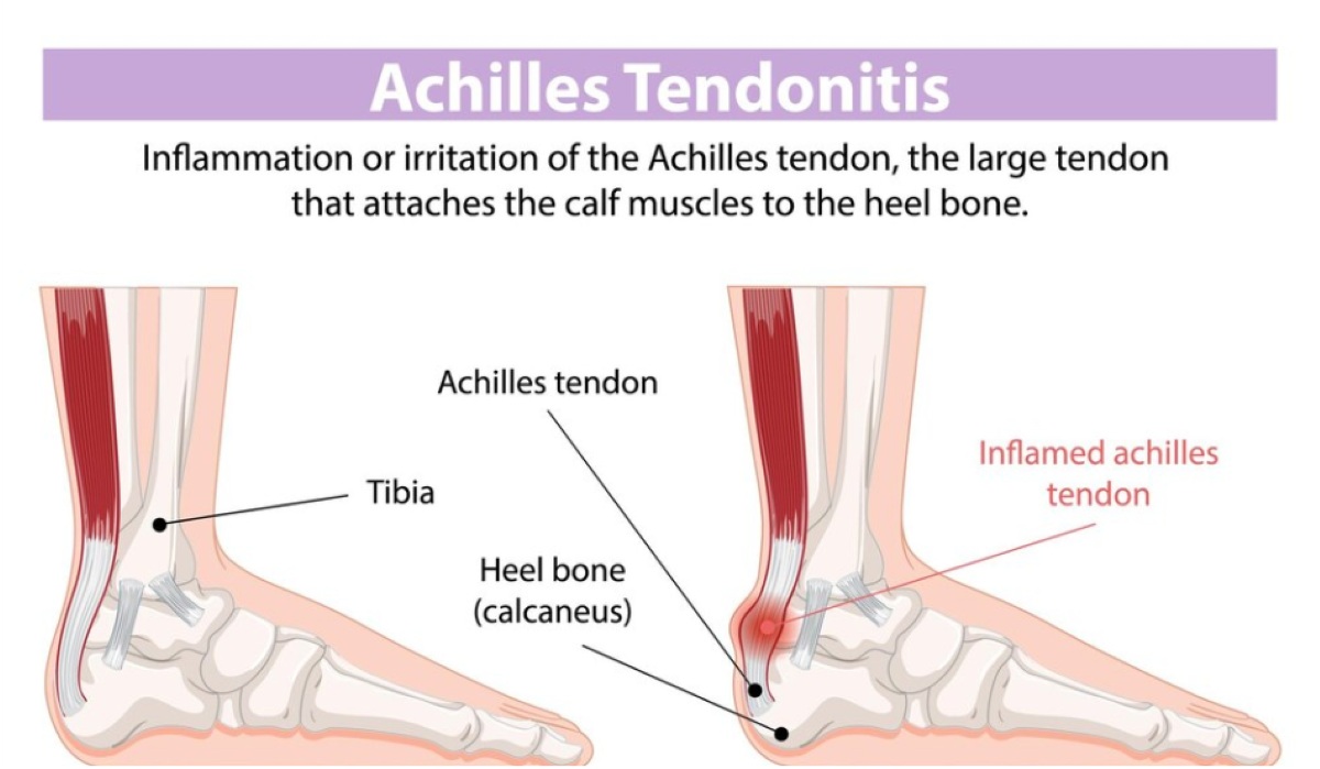 Cara Perkuat Tendon untuk Kesehatan dan Performa Fisik