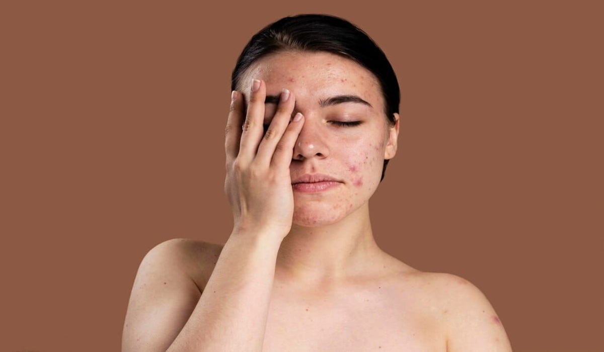 Punya Masalah Jerawat Pada Kulit? Ini Solusi dari Dermatolog Berpengalaman 