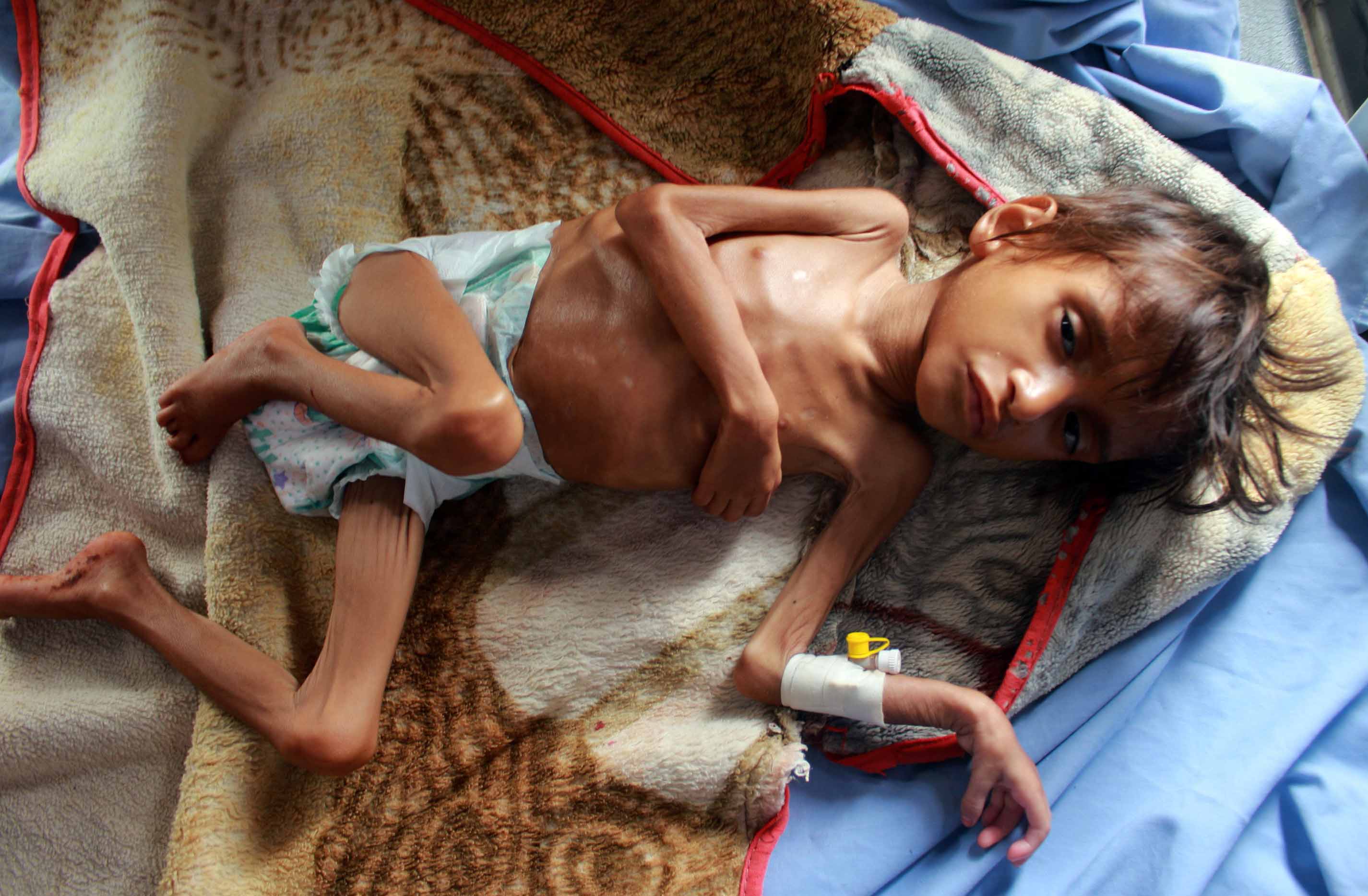 Konflik Panjang Menghancurkan Sistem Kesehatan di Yaman