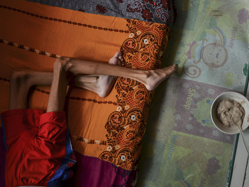 Penderita Gizi Buruk Di Pangandaran