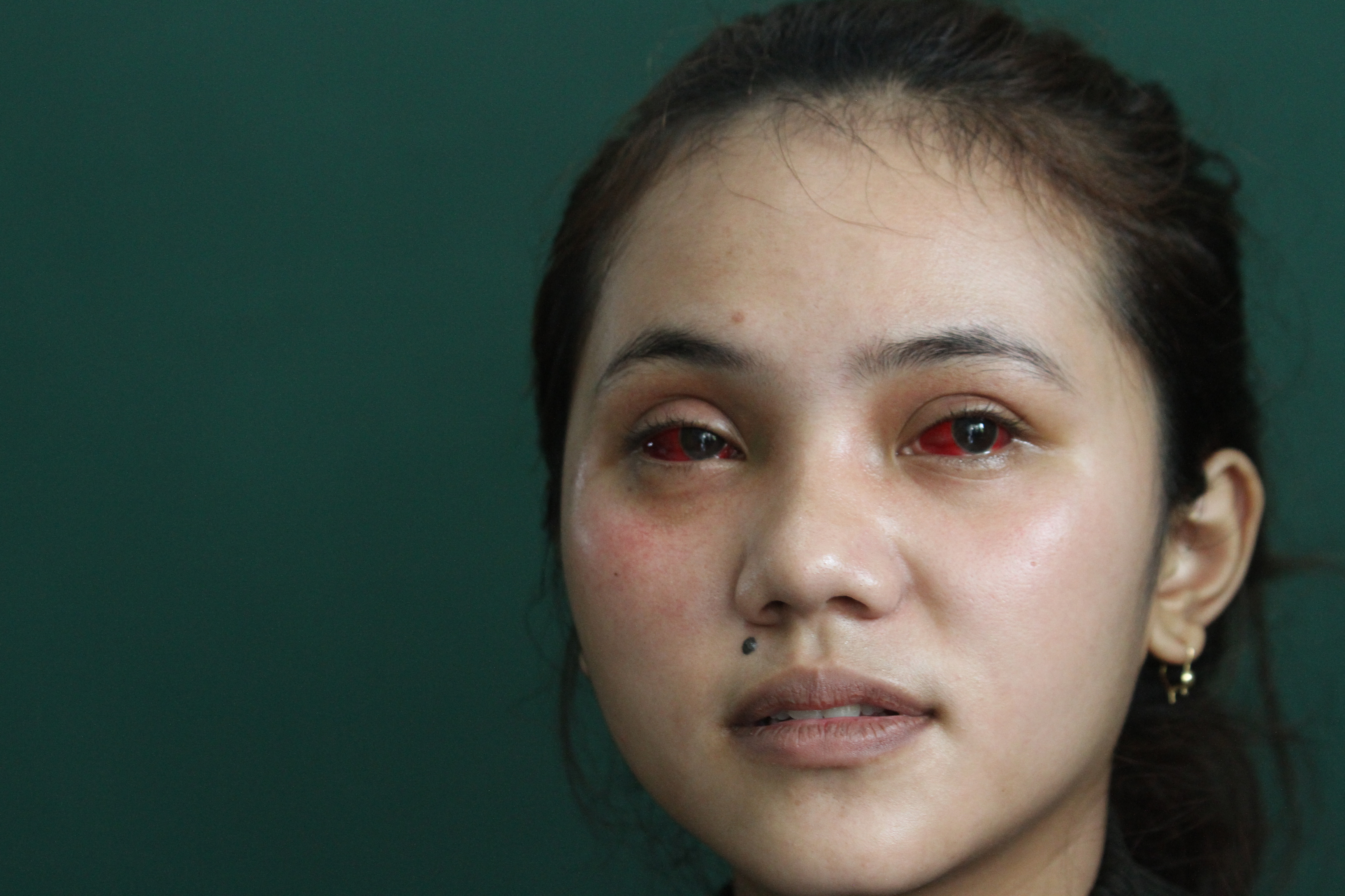  Korban Luka  Tragedi Kanjuruhan