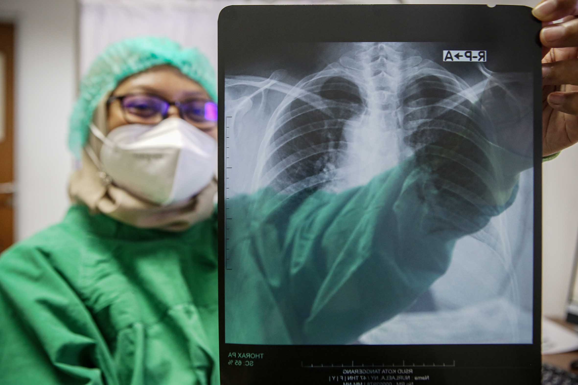 Deteksi Tuberkulosis di RSUD Tangerang