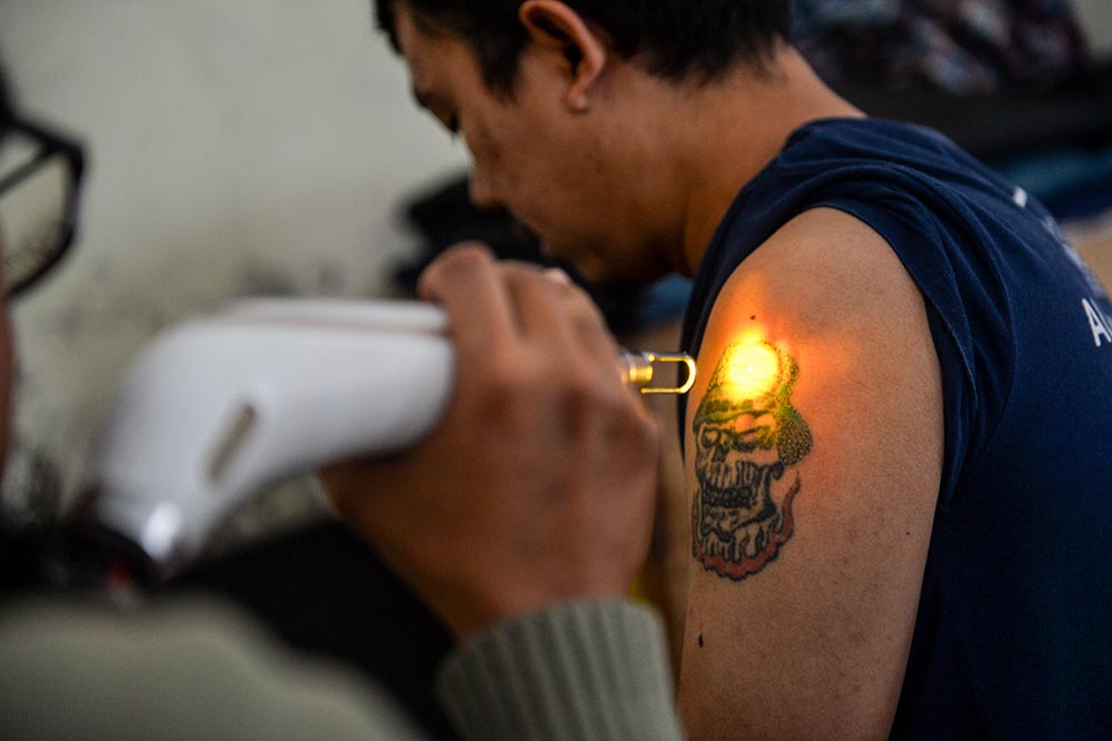 Hapus Tato Gratis di Bandung